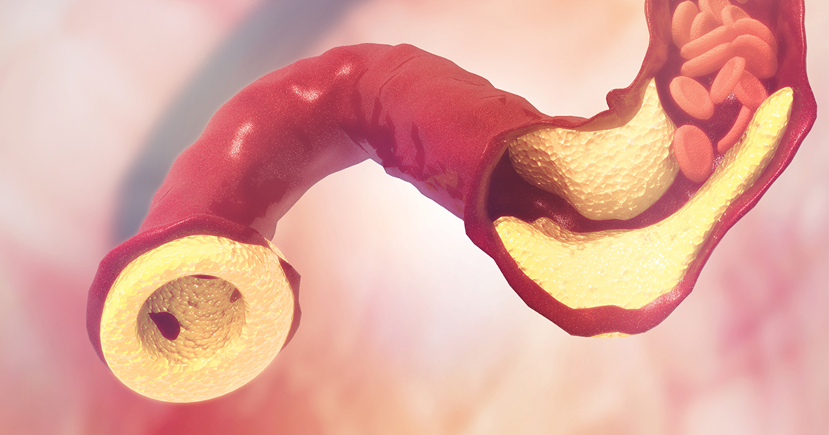 Don’t Let Cholesterol Ruin Kidney Health