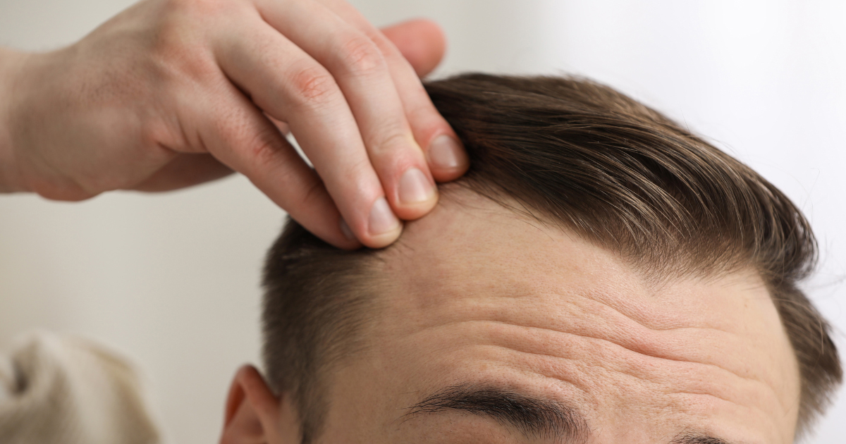 Receding Hairline: How’s Hair Loss Connected to Your Kidneys?