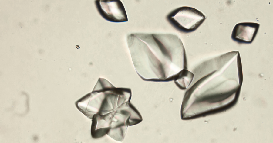 Is High Uric Acid Silently Damaging Your Kidneys?
